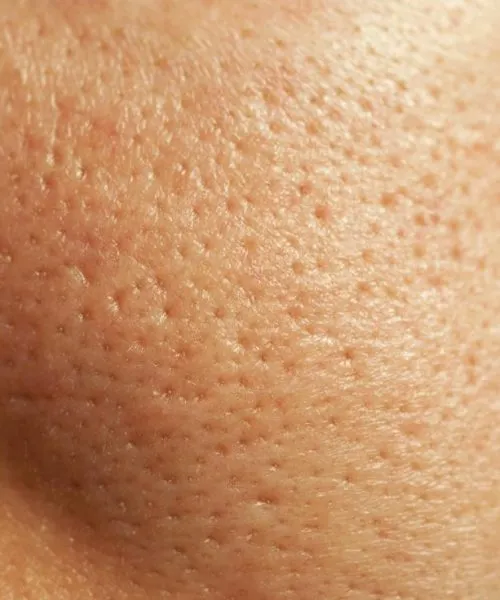 Open Pores Treatment